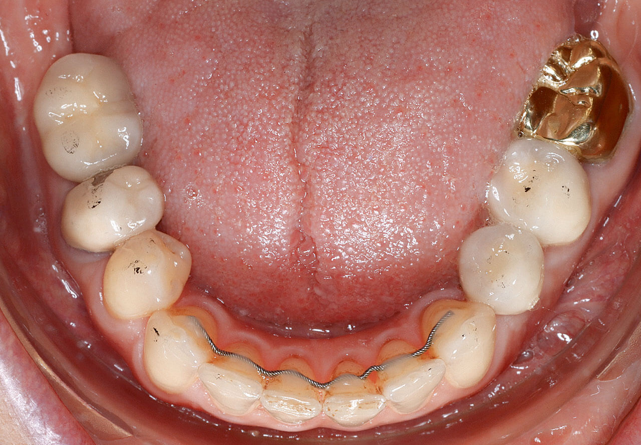 Abb. 9a bis e Prothetisch/konservierende Versorgung mit odontoplastischem Kompositaufbau an Zahn 12 und Kronenversorgung an Zahn 22 sowie Implantatversorgung an Zahn 35 und Krone an Zahn 46.