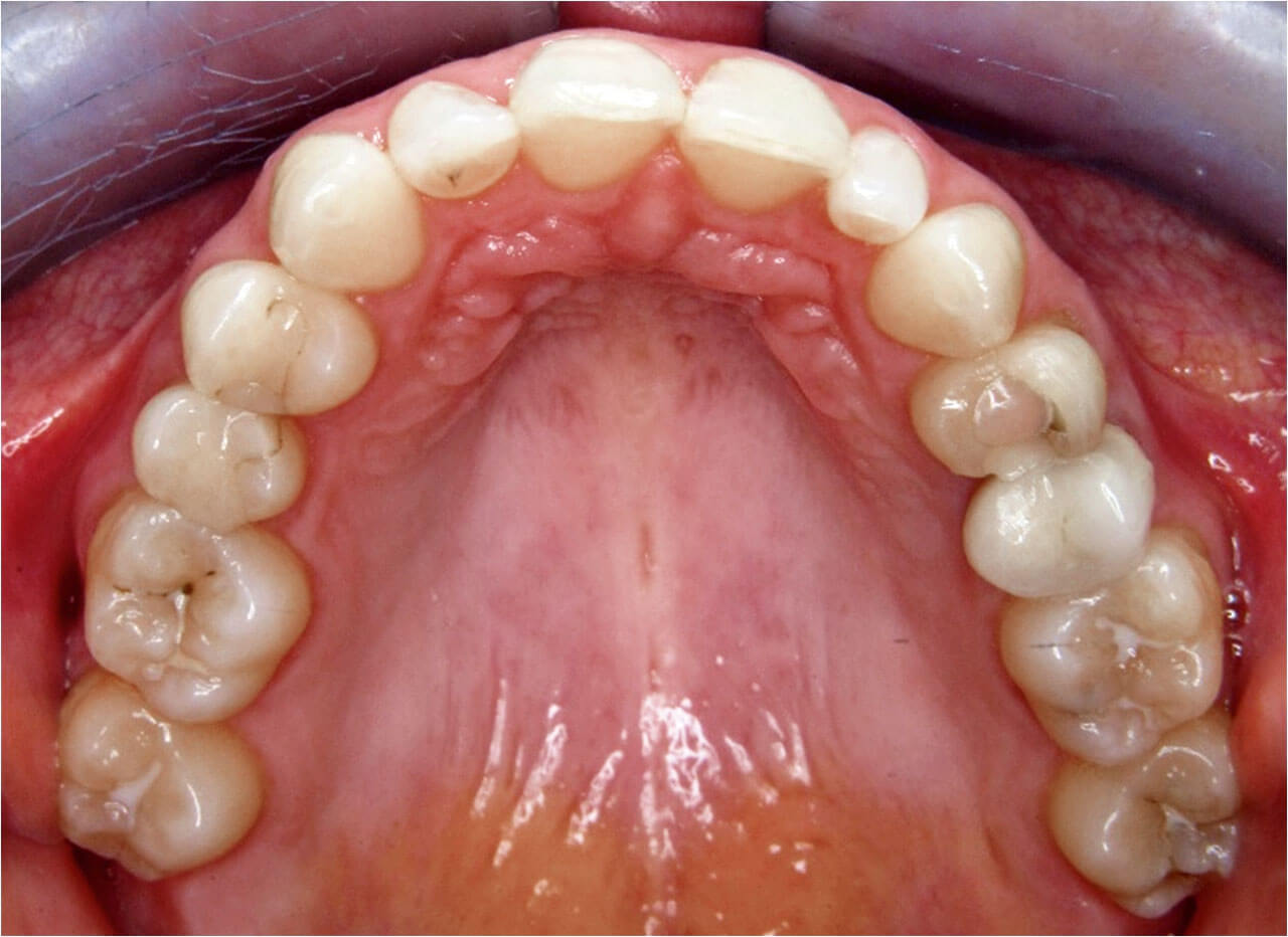 Abb. 2 Erwachsene Patientin mit dentoalveolärer Mittenverschiebung im Ober- und Unterkiefer. Korrektur im Oberkiefer durch unilaterale knochengetragene Distalisationsapparatur.