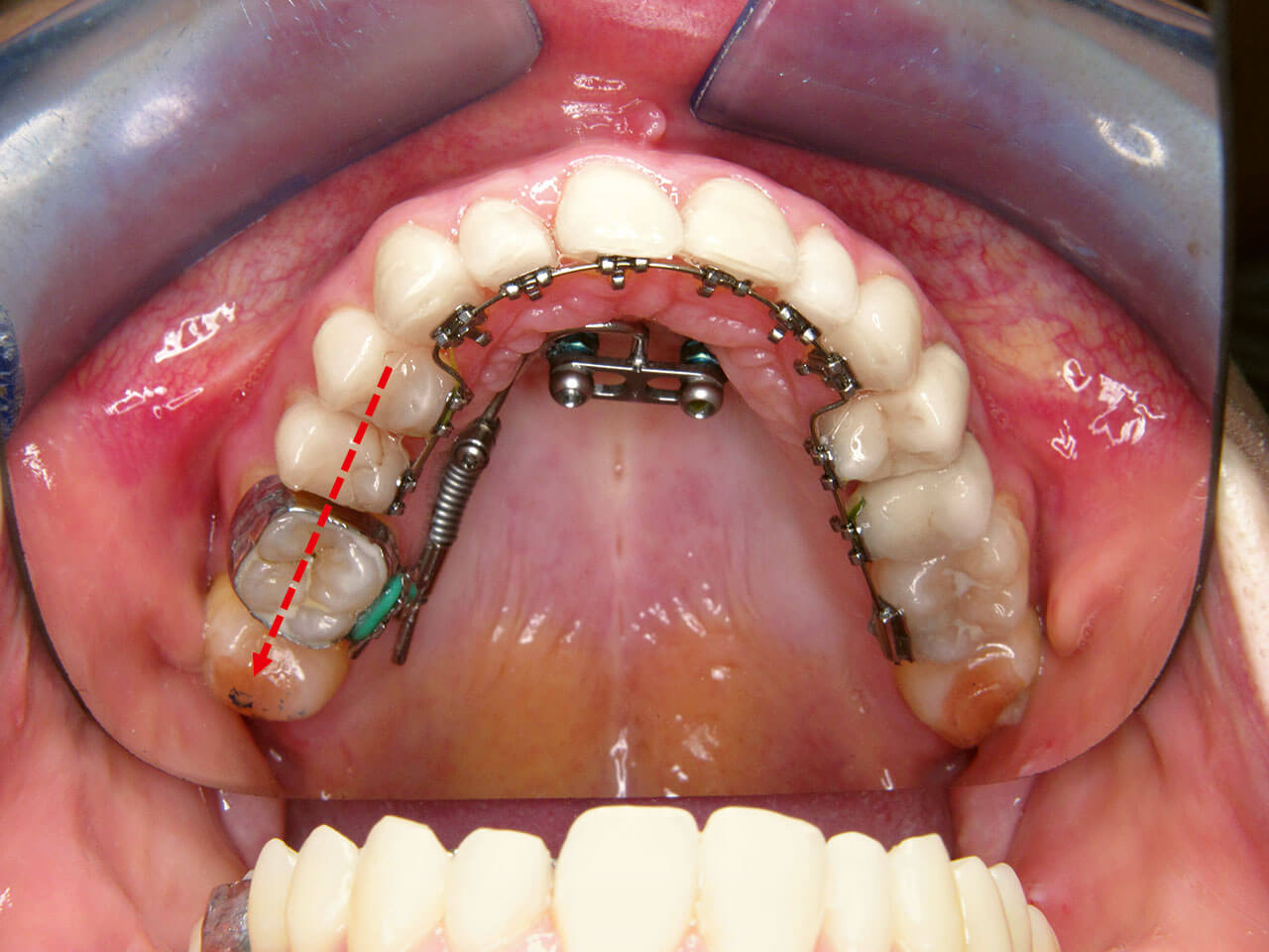 Abb. 2 Erwachsene Patientin mit dentoalveolärer Mittenverschiebung im Ober- und Unterkiefer. Korrektur im Oberkiefer durch unilaterale knochengetragene Distalisationsapparatur.