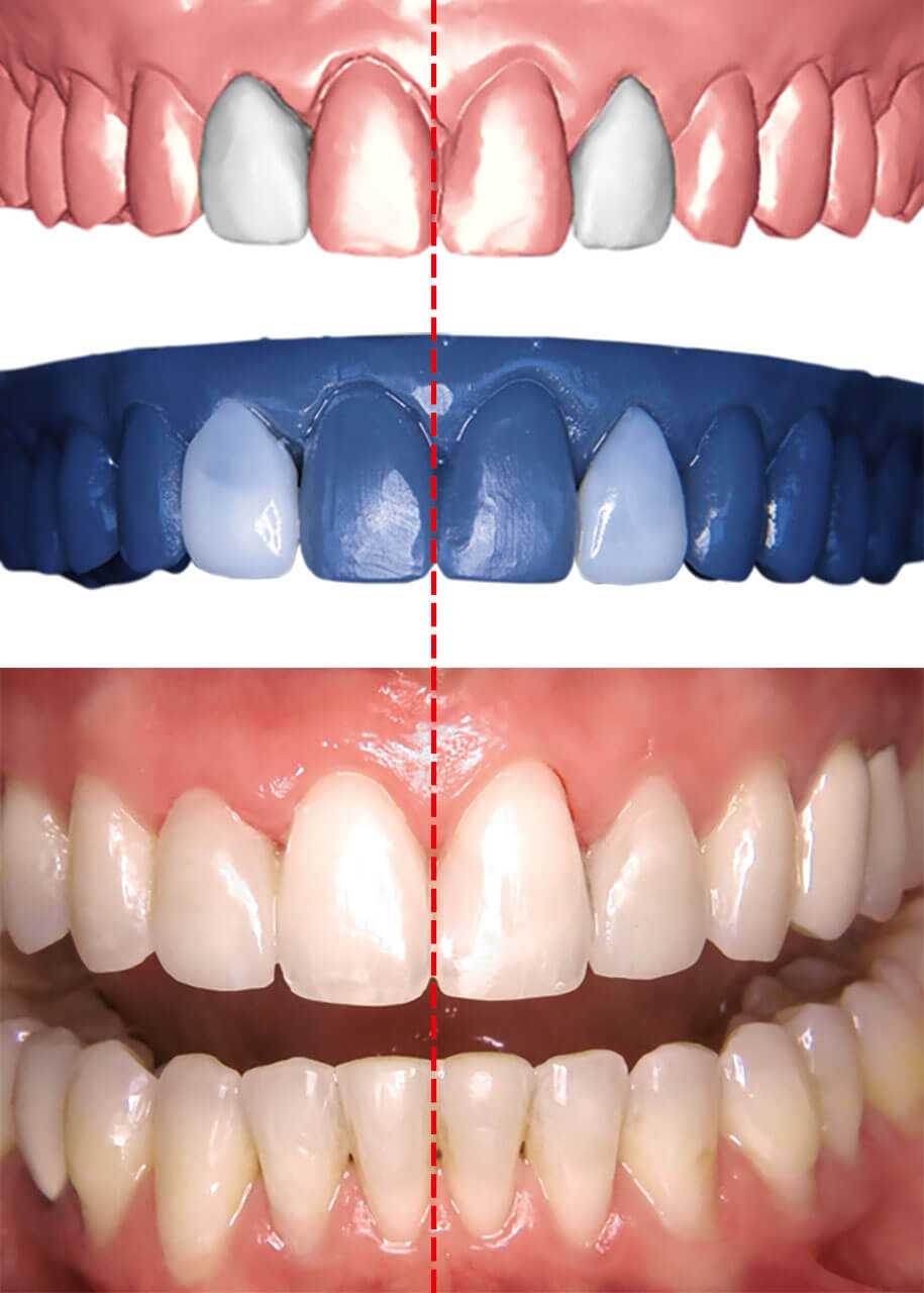 Abb. 4 Smile Design (OnyxCeph3) zur provisorischen Umformung der hypoplastischen Zähne 12 und 22. 3-D-Druck der provisorischen Veneers (Formlabs 3) und zwanglose Mundöffnung.
