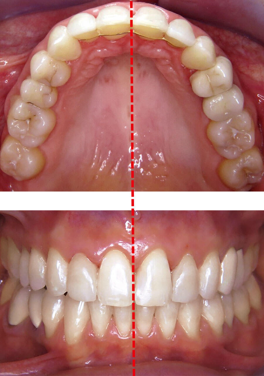 Abb. 5 Vergleich Behandlungsbeginn und -ende. Dentoalveoläre Kompensation der Ober- und Unterkiefermitte.