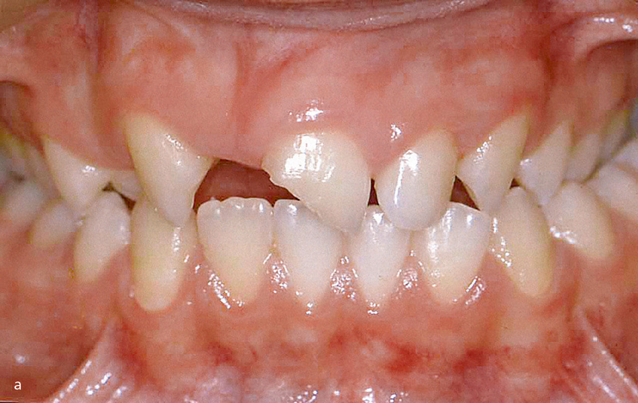 Abb. 1 Die Patientin stellte sich im Alter von 11 Jahren nach einem traumatischen Verlust der Zähne 11 und 12 vor. 