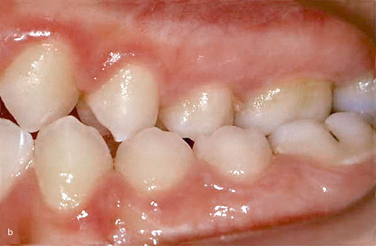 Abb. 1 Die Patientin stellte sich im Alter von 11 Jahren nach einem traumatischen Verlust der Zähne 11 und 12 vor.