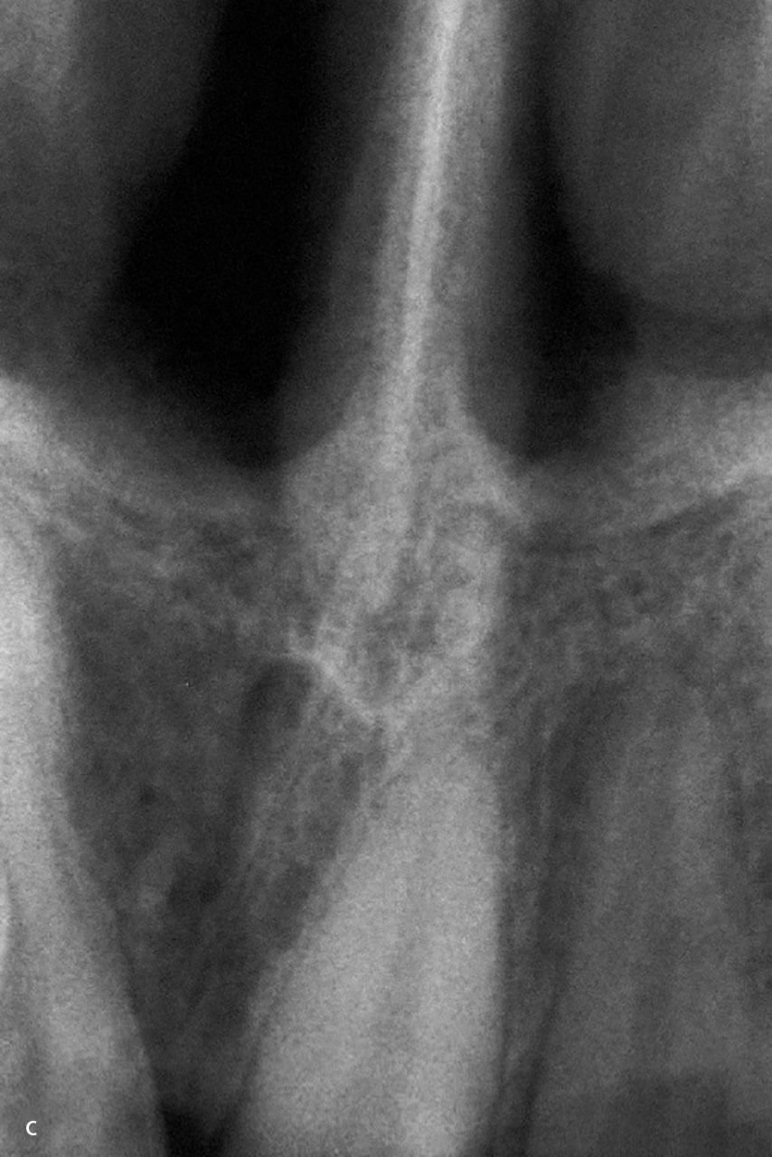 Abb. 5a bis c OPG mit Ausschnittsvergrößerung und Zahnfilm Regio 13/21 mit Darstellung der versetzten ossären Strukturen (Sutura, Foramen incisivum).