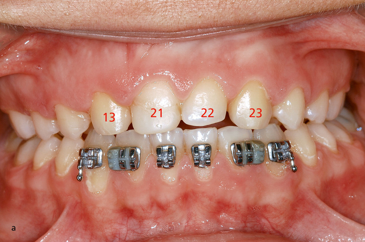 Abb. 6a bis c Finishing: Kieferorthopädisch, parodontal-chirurgisch, konservierend, prothetisch.