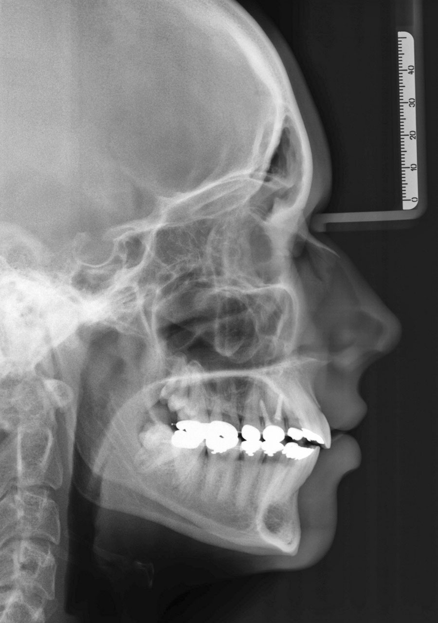 Abb. 3a Initiales Orthopantogramm mit Retention der dritten Molaren und deutlicher Absenkung der Kieferhöhle im Bereich der Extraktionslücke von Zahn 26.