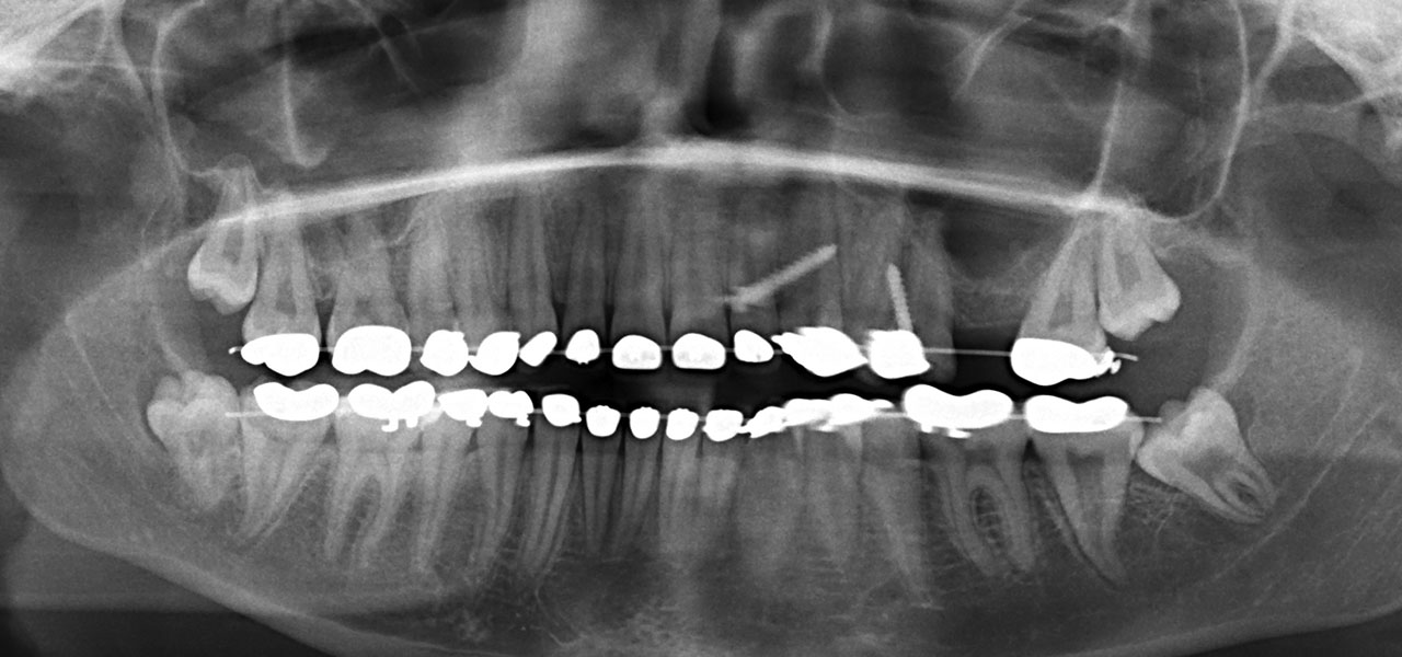 Abb. 3b Initiales Orthopantogramm mit Retention der dritten Molaren und deutlicher Absenkung der Kieferhöhle im Bereich der Extraktionslücke von Zahn 26.