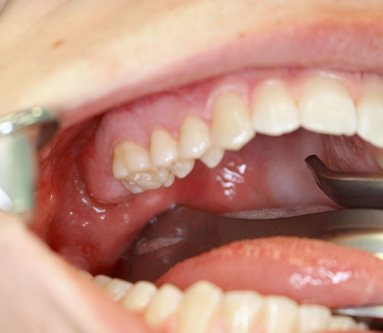 Abb. 2 Bei der klinischen Untersuchung zeigt sich, dass Zahn 17 fehlt. Der Kieferkamm scheint distal von Zahn 16 etwas verdickt zu sein, die Schleimhaut ist unauffällig.