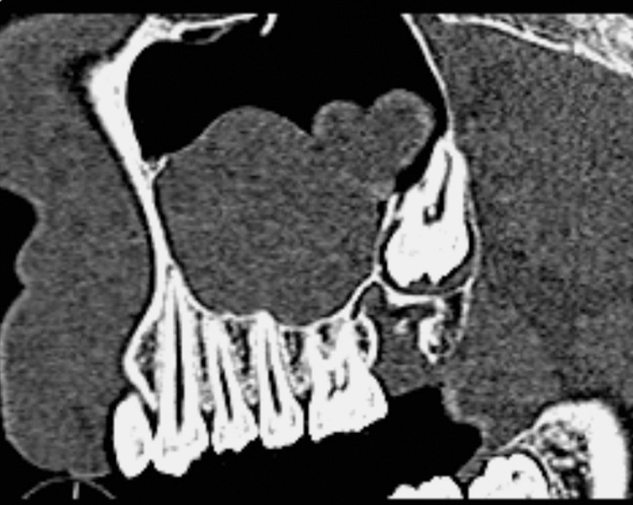 Abb. 3a In der digitalen Volumentomografie ist über der Krone des retinierten Zahns ein scharf begrenzter, osteolytischer Prozess zu erkennen, der vereinzelte, kleinflächige Verschattungen aufweist. Als Nebenbefund findet sich eine Retentionszyste in der rechten Kieferhöhle.