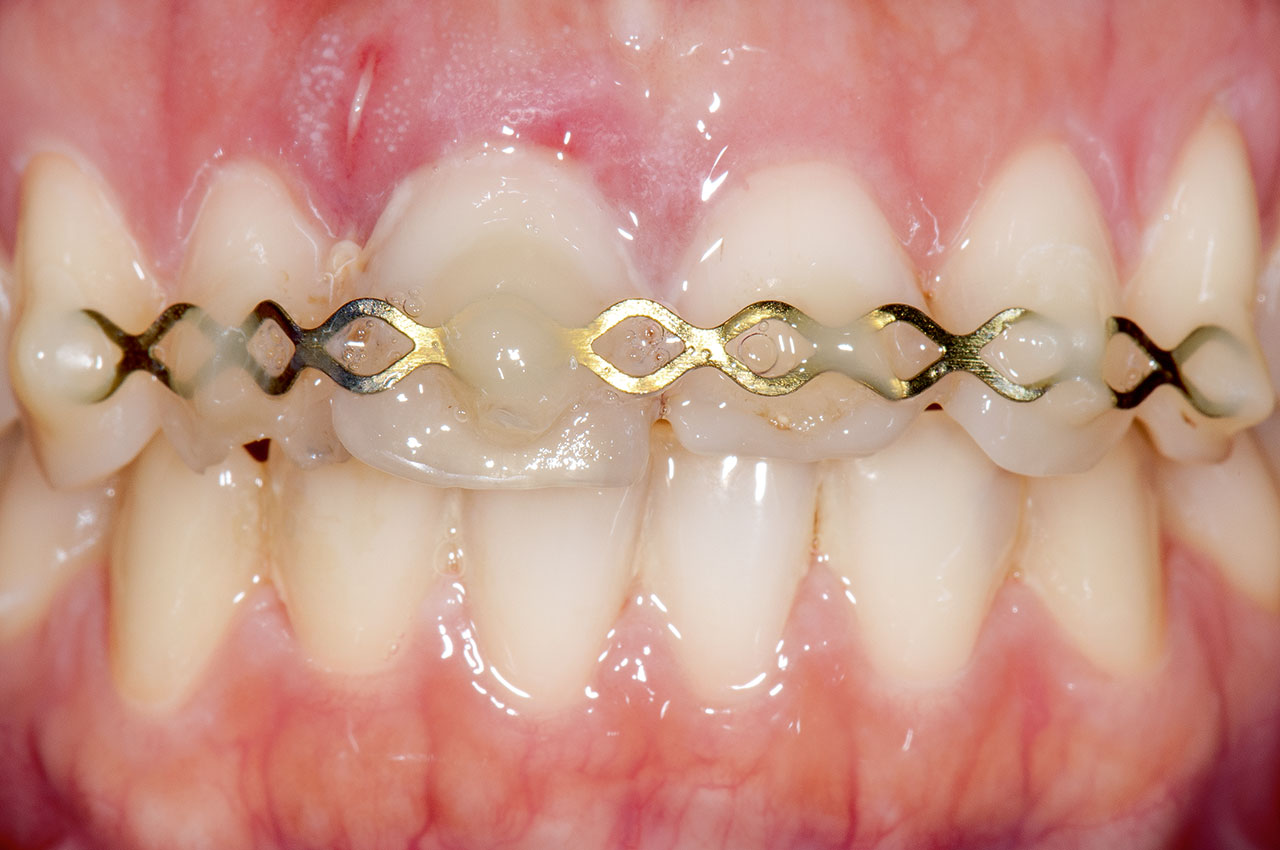 Abb. 1 Patientenvorstellung mit Horizontalfraktur an Zahn 11 und Teilfraktur an den Zähnen 12 und 21.