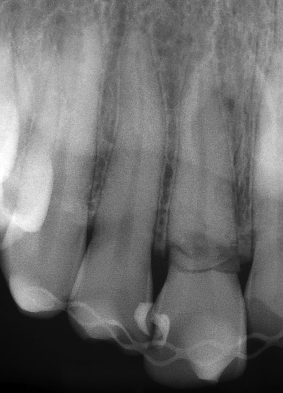 Abb. 2 Horizontalfraktur an Zahn 11 und Teilfraktur an den Zähnen 12 und 21 – Situation im Röntgenbild.