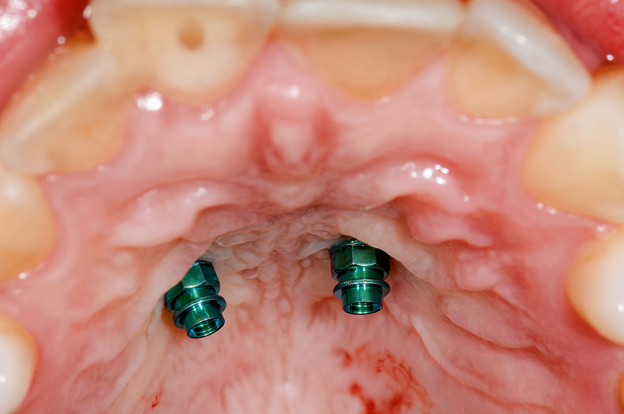 Abb. 4 Extrusion von Zahn 11 mithilfe der Herstellung einer indirekten Verankerungseinheit an palatinal gesetzten Miniimplantaten.
