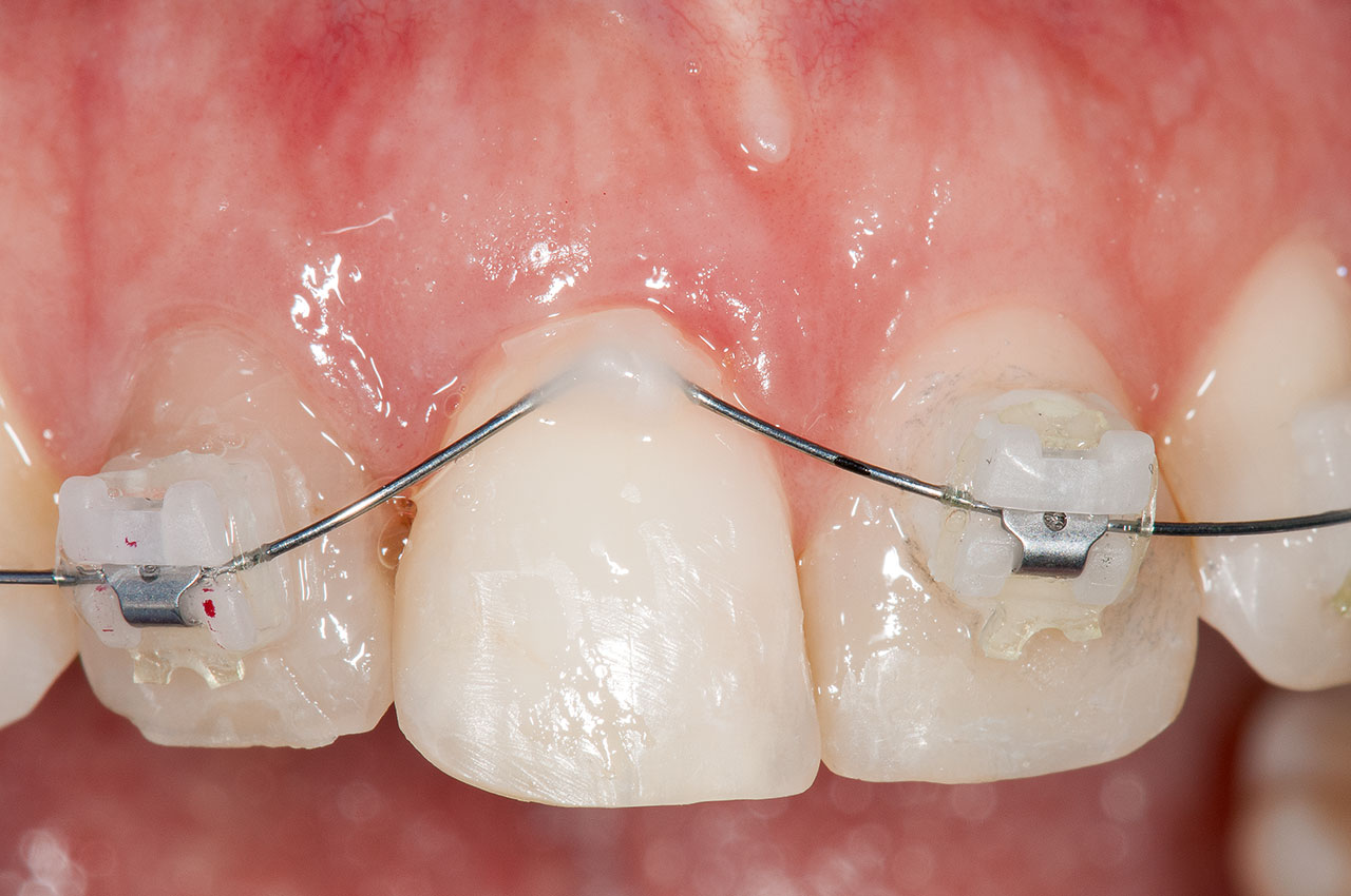 Abb. 5 Extrusion von Zahn 11 mithilfe der Herstellung einer indirekten Verankerungseinheit an palatinal gesetzten Miniimplantaten.