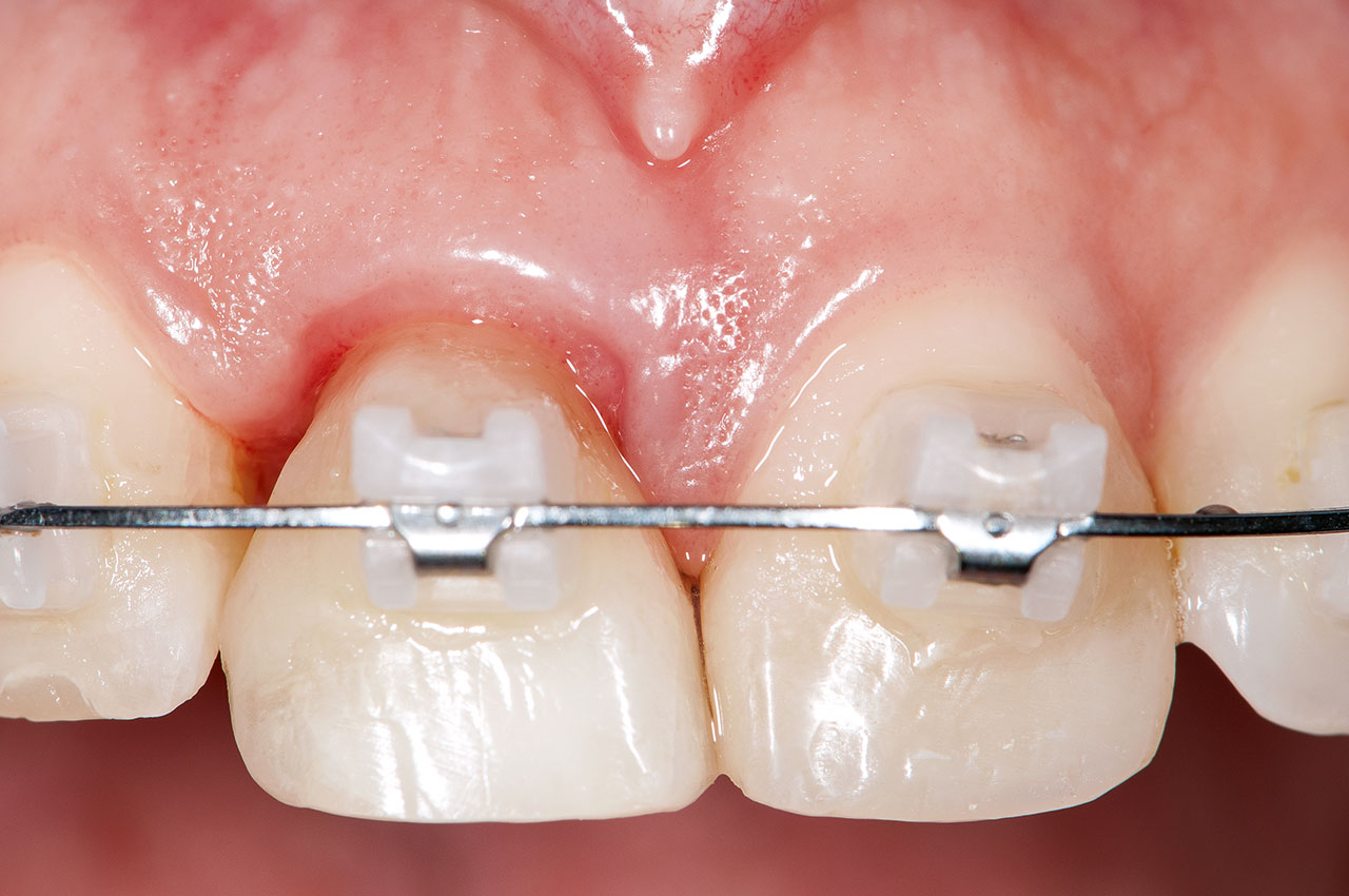 Abb. 7 Der Zahn 11 wurde nach seiner Extrusion präpariert und für ein Langzeitprovisorium abgeformt.