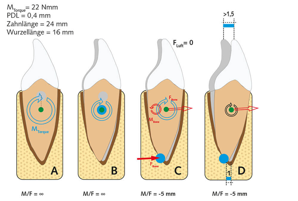 Abb. 2  Mechanistisches Modell zur Entstehung des Ruder­booteffekts während der physikalischen Phase der Zahnbewegung. A: Das blaue Torquemoment von 22 Nmm aus der festsitzenden Apparatur hat eine Torqueachse, die sich im Laufe der initialen Zahnbewegung vom grauen Punkt zum grünen Widerstandszentrum verschiebt. B: Dies führt am Apex zu einer kleinen initialen Zahnbewegung von 0,1–0,2 mm innerhalb des Parodontalligaments, wobei der als erstes entstehende Apex-Kortikalis-Kontakt die weitere Auslenkung bremst, während limbal in Bewegungsrichtung noch ligamentäre Bewegungskapazität verbleibt. Gleichzeitig sinkt das effektive Torquemoment unter 22 Nmm, weil es durch das Parodontalligament mit E = 5 MPa ein Gegenmoment erfährt. C: Der Kontakt der Wurzel (E = 18 GPa) mit der Alveoleninnenkortikalis (E = 14 GPa) 4 führt zu einer roten Reaktionskraft FBone von etwa 1,5 N auf den Apexbereich, die am grünen Widerstandszentrum zu einem roten Antitorquemoment MBone von 15 Nmm führt. Dieses Gegenmoment verkleinert das ursprüngliche blaue Torquemoment auf ein Resttorquemoment von vielleicht 7 Nmm. Zusammen mit der roten Kraft ergibt sich ein M/F-Quotient am Widerstandszentrum von etwa +5 mm: die kontrollierte Kippung ist etabliert. D: Mit dem Kräftesystem der kontrollierten Kippung dehnt sich der limbale Knochen noch etwas, weil seine Verformbarkeit etwa 40 % größer ist als die an der apikalen Basis5. Dadurch bewegt sich die Krone noch etwa 0,5 mm weiter nach ventral. Dies ist der Punkt, an dem Transmitter-gesteuert die biologische Phase der Zahnbewegung beginnt.