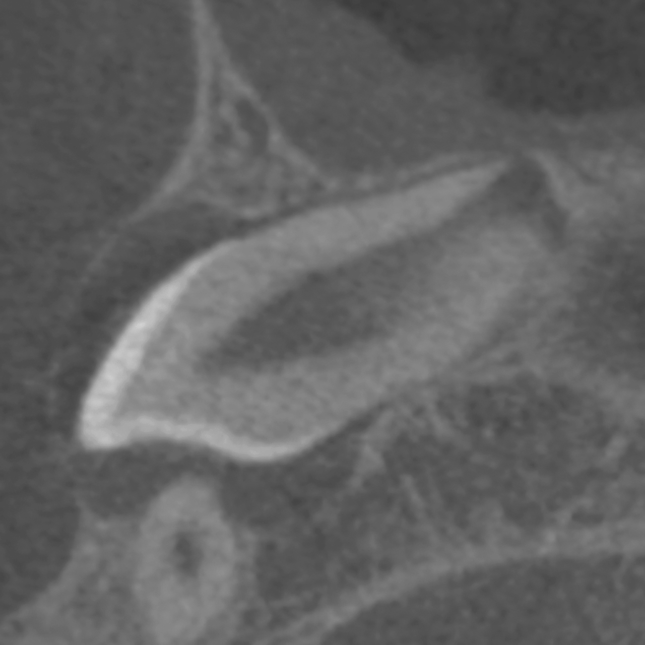 Abb. 3: Schräg-sagittale Ansicht (von schräg seitlich), exemplarische Darstellung der vollständigen Einsehbarkeit des kranialen Anteils des Parodontalraums des Zahns 13. 