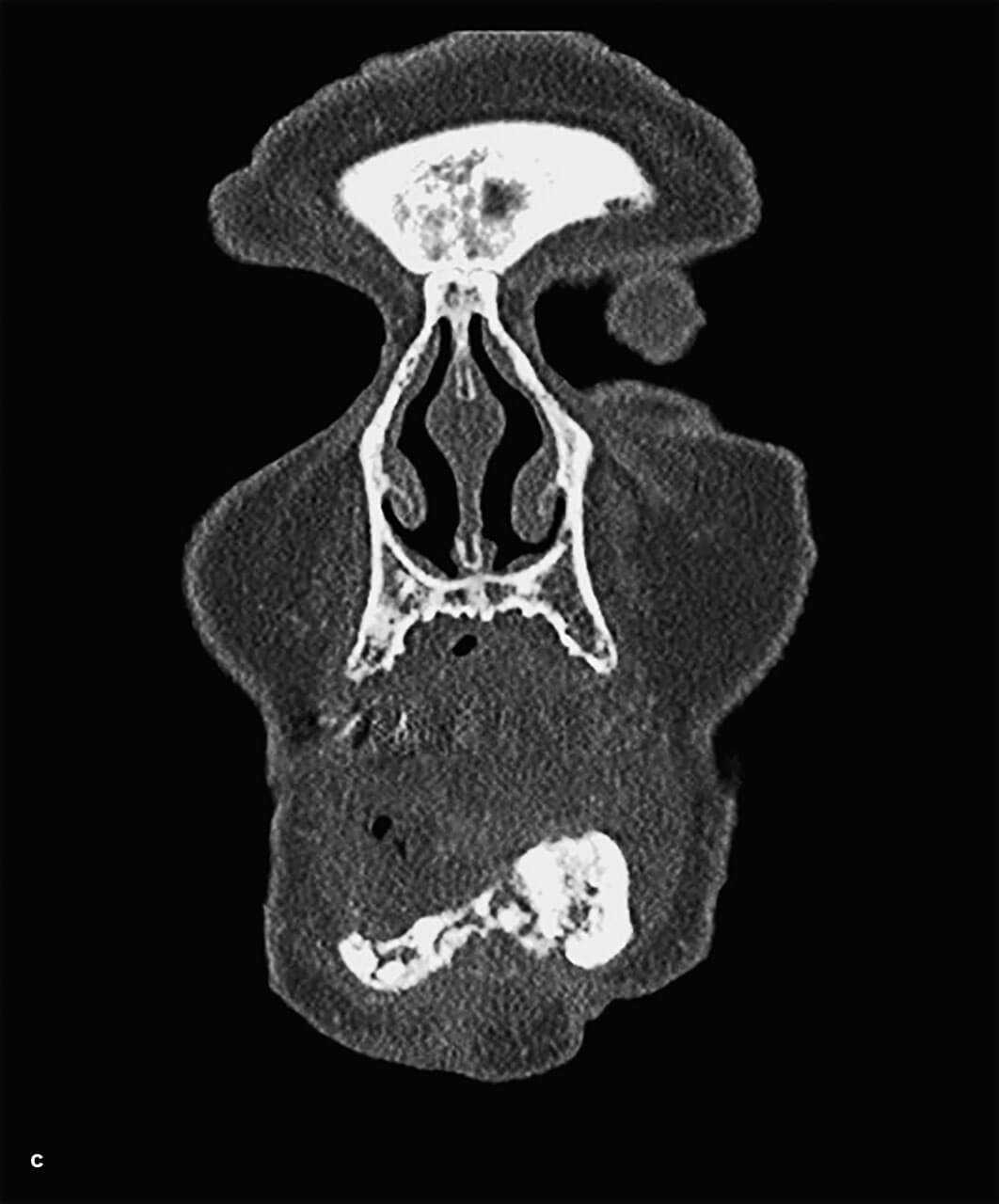 Abb. 3a bis e AR-ONJ Stadium 3 mit enoral großflächig freiliegendem Knochen im Bereich der Unterkieferfront sowie infektiösen Entzündungs­zeichen (a), extraoraler Fistelung (b) und CT-morphologischer Destruktion des gesamten Unterkiefers (c bis e).