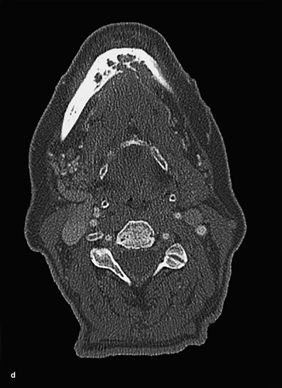 Abb. 3a bis e AR-ONJ Stadium 3 mit enoral großflächig freiliegendem Knochen im Bereich der Unterkieferfront sowie infektiösen Entzündungs­zeichen (a), extraoraler Fistelung (b) und CT-morphologischer Destruktion des gesamten Unterkiefers (c bis e).