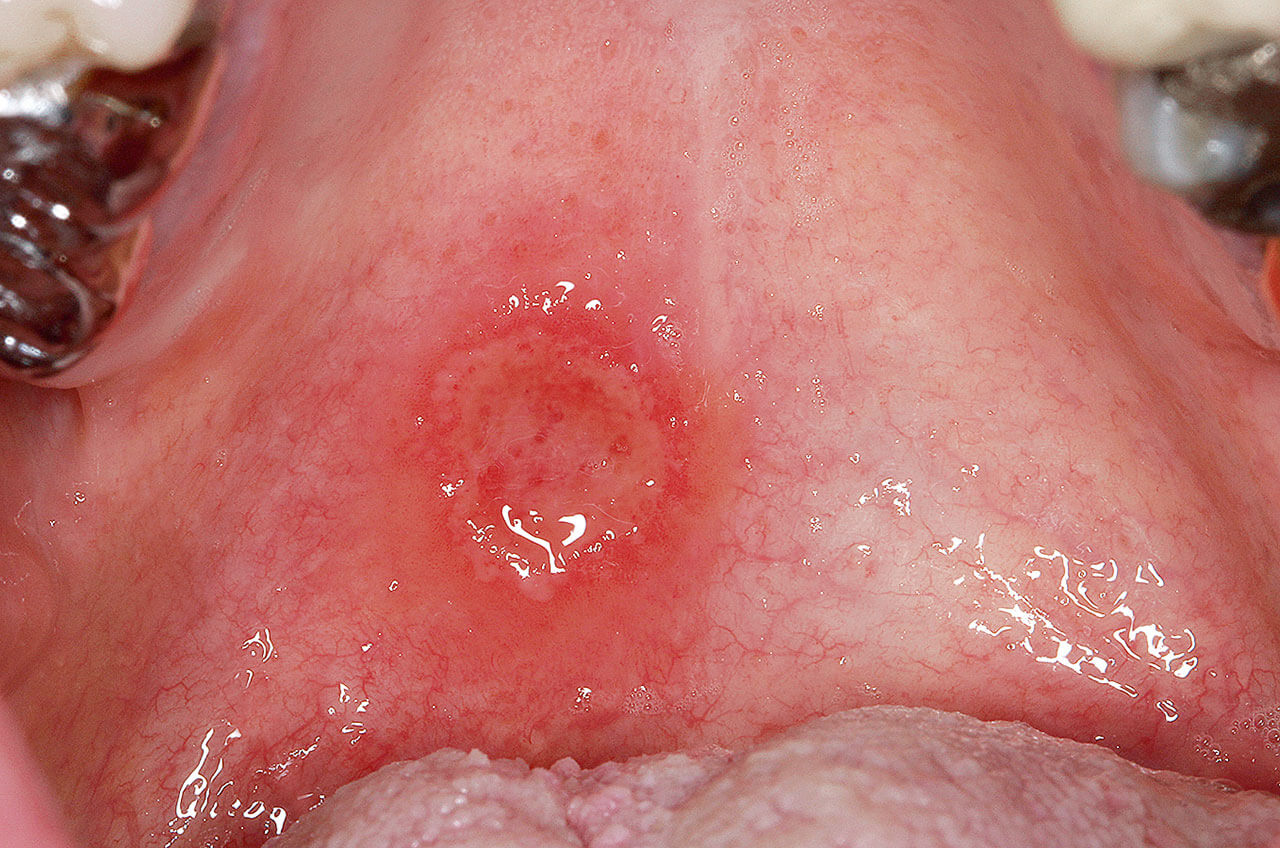 Abb. 2 Sekundäre Syphilis (Lues II): Plaque muqueuse am Gaumen bei einem 56-jährigen männlichen Patienten.
