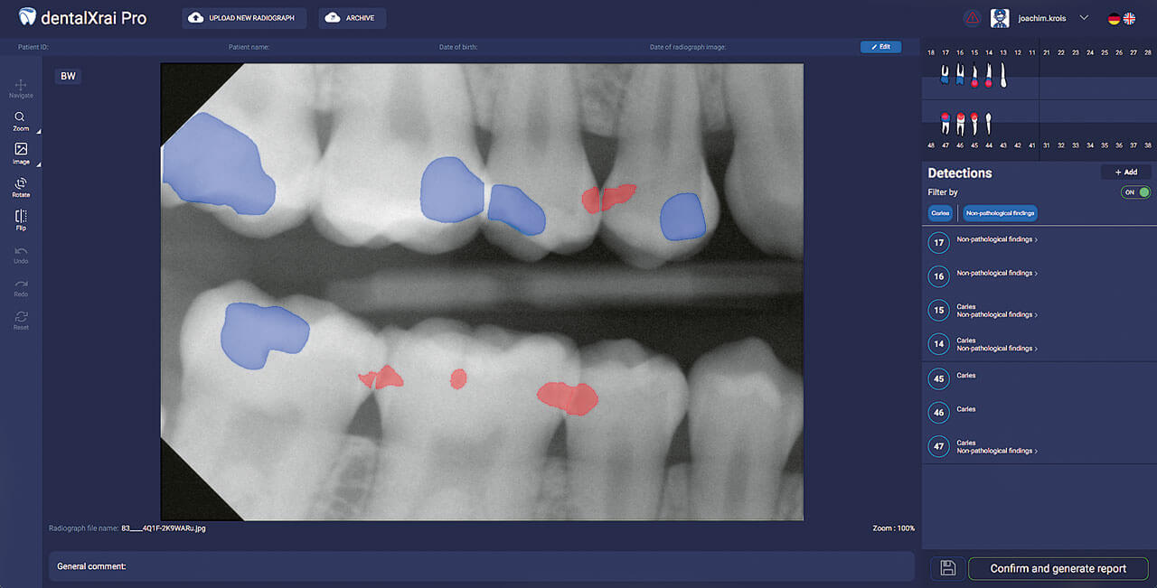 Abb. 2  Die Software dentalXrai Pro ist ein KI-basiertes Diagnose­unterstützungssystem für dentale Röntgenbilddaten. Die Software unterstützt die Lokalisierung und Klassifizierung von Zähnen sowie die Erkennung und Doku­men­tation von Pathologien (Karies und apikale Läsionen) sowie nicht­pathologischen Strukturen (Füllungen, Kronen, Implantate, Brücken und Wurzelkanalfüllungen). Sie zählt zu den weltweit ersten kommerziell vertriebenen KI-basierten Lösungen für zahnmedizinische Anwendungen.