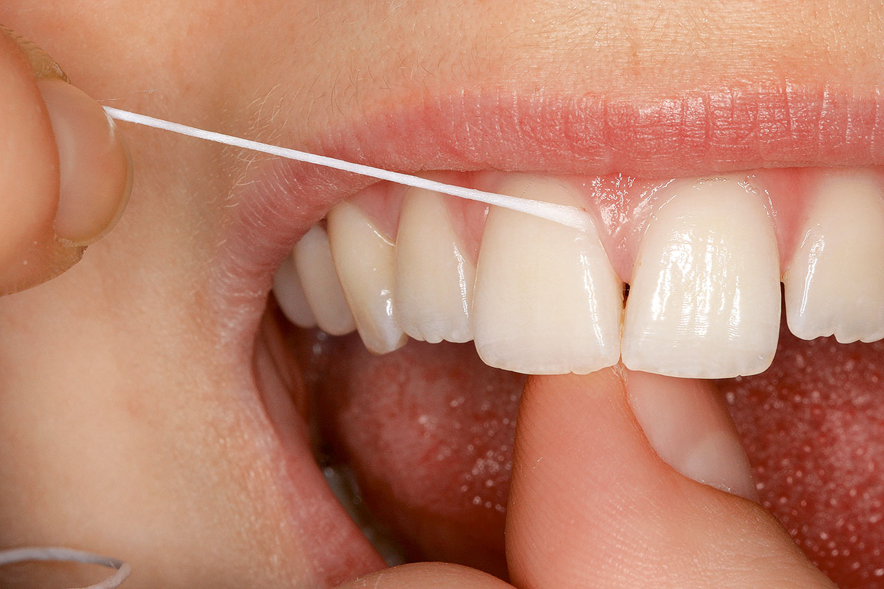 Abb. 7 Häusliche interdentale Plaquekontrolle als Beispiel für primäre parodontale Prävention.