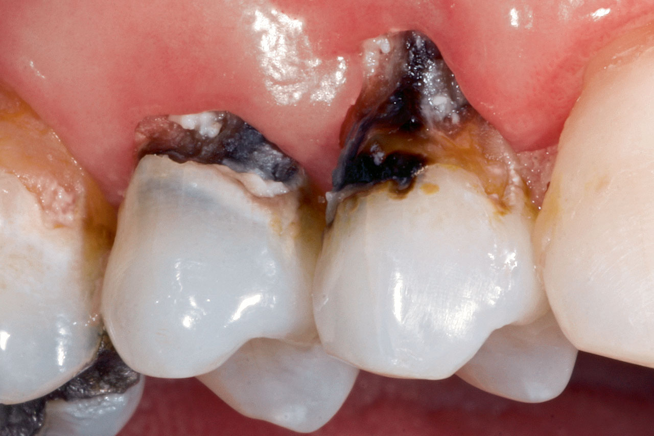 Abb. 1b ...  ausgeprägte aktive Wurzelkariesläsionen (Kavitation > 0,5mm/ICDAS: W2) an den Zähnen 14 und 15 mit Unterminierung des Schmelzes; ...
