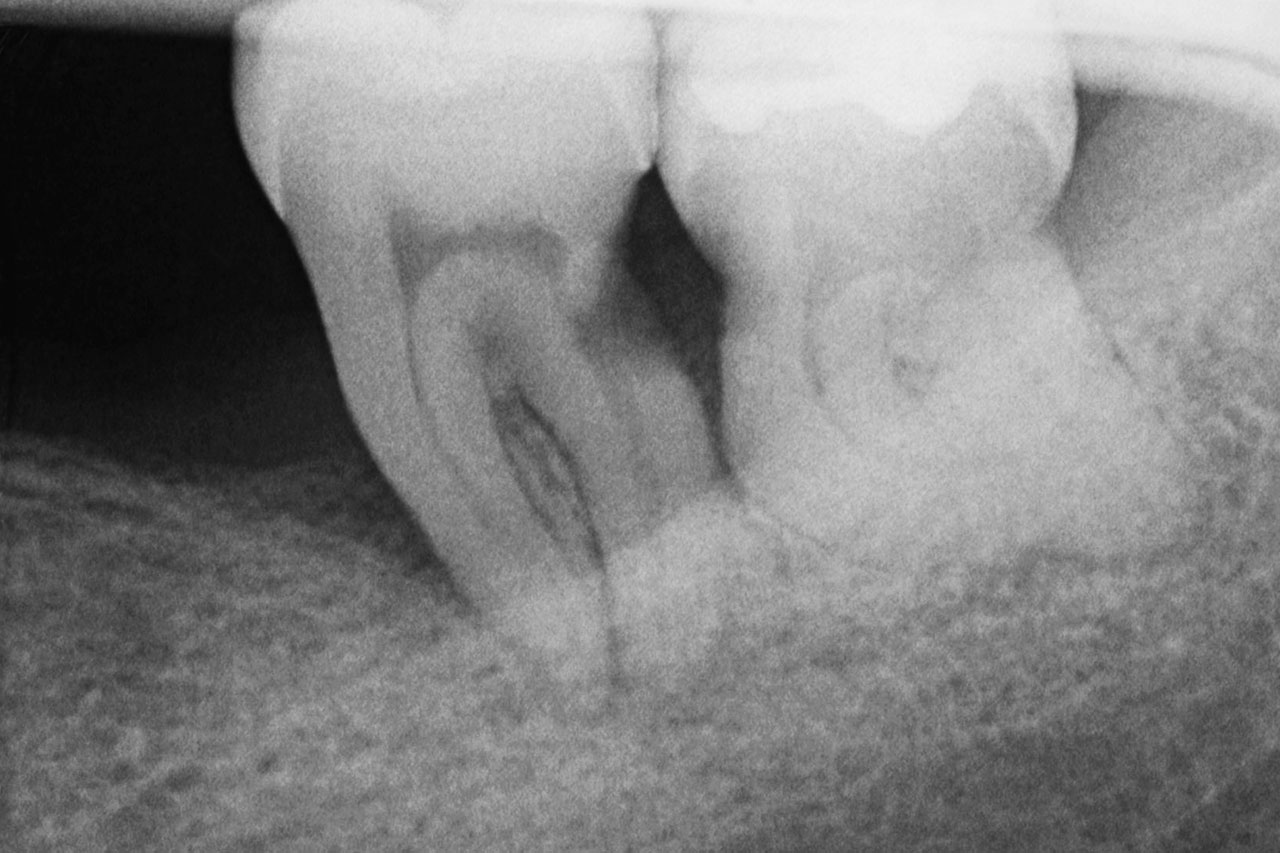 Abb. 1c ... Röntgenaufnahme einer tiefen Wurzelkaries an der distalen Wurzel des parodontal geschädigten Zahns 37 sowie beginnende Wurzelkaries an der mesialen Wurzel des Zahns 38.