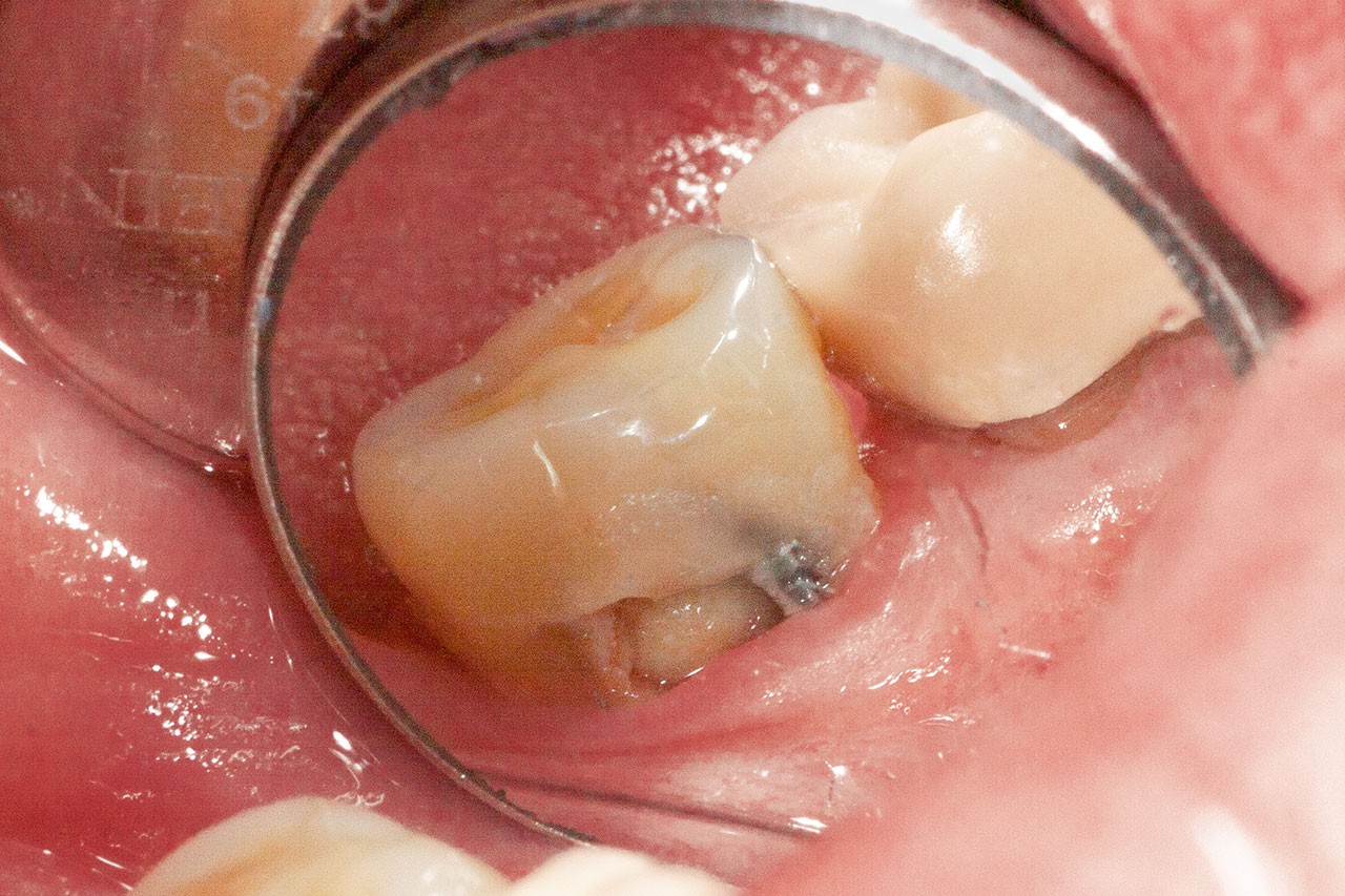 Abb. 4a Restauration einer Wurzelkariesläsion vestibulär an Zahn 37: ausgedehnte Wurzelkaries (ICDAS-Score: W2), die Teile des Zahnschmelzes unterminiert; ...