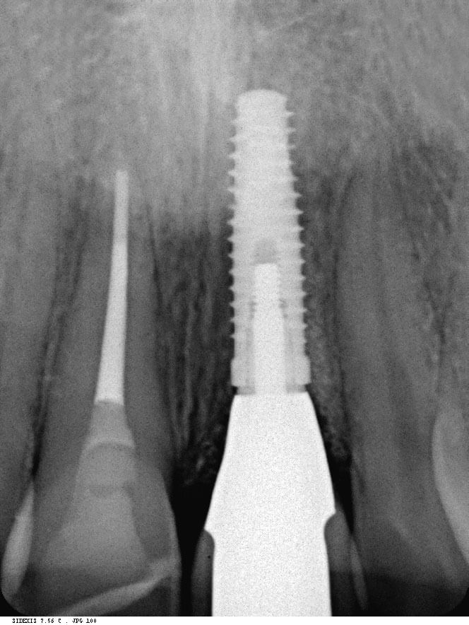 Abb. 26  Das postrestaurative Röntgenbild zeigt ein regelrecht osseointegriertes Implantat.