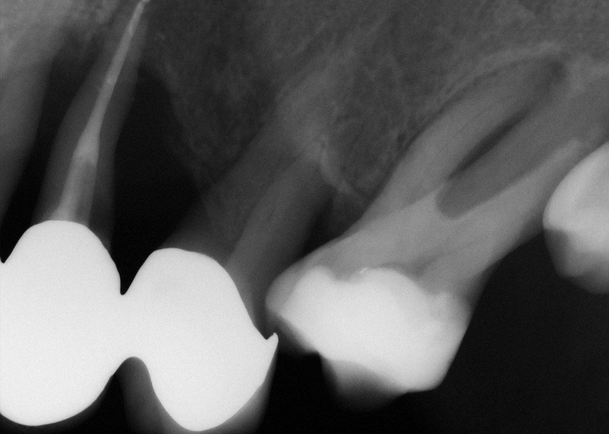 Abb. 1 Intraorale Tubusaufnahme in apikaler Projektion der stark parodontal geschädigten Zähne 23 bis 27 (28 retiniert). Aufgrund der Gaumenwölbung ist eine Parallelität des Sensors (hier Festkörpersensor) zur Zahnachse absolut nicht möglich, was sich auch in der dadurch bedingten Verzerrung der Wurzeln auf der Aufnahme manifestiert.