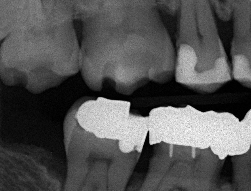 Abb. 2 Bissflügelaufnahme der Ober-/Unterkiefer­molarenregion rechts. Der marginale Knochenverlauf und damit auch die parodontal bedingten Knocheneinbrüche sind gut erkennbar.