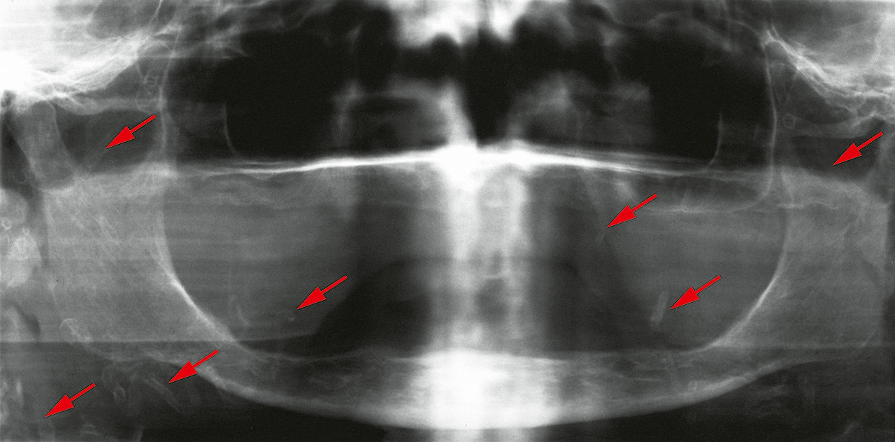 Abb. 2 Panoramaschichtaufnahme mit röntgenologisch sichtbar kalzifizierten Gefäßen (rote Pfeile).
