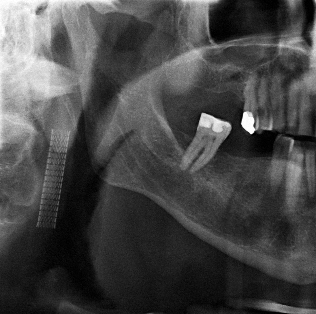Abb. 3 Ausschnitt einer Panoramaschichtaufnahme mit röntgenologisch sichtbarer Stent­implantation in der rechten A. carotis interna.