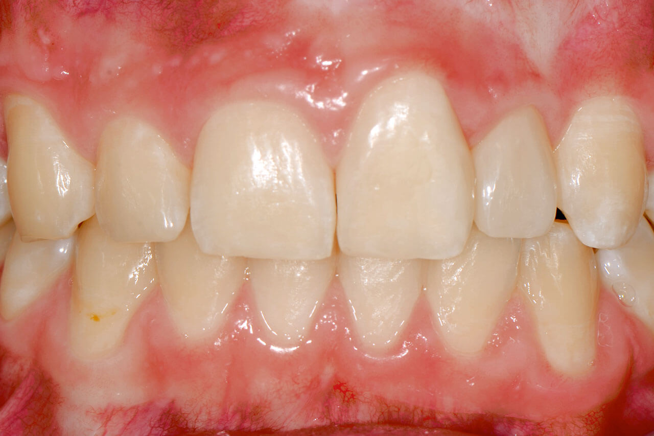 Abb. 2  Situation nach restaurativer Versorgung der Zähne 12 inzisal, 11 inzisal, 21 mesial und distal und 22 vestibulär-approximal mittels Komposit.