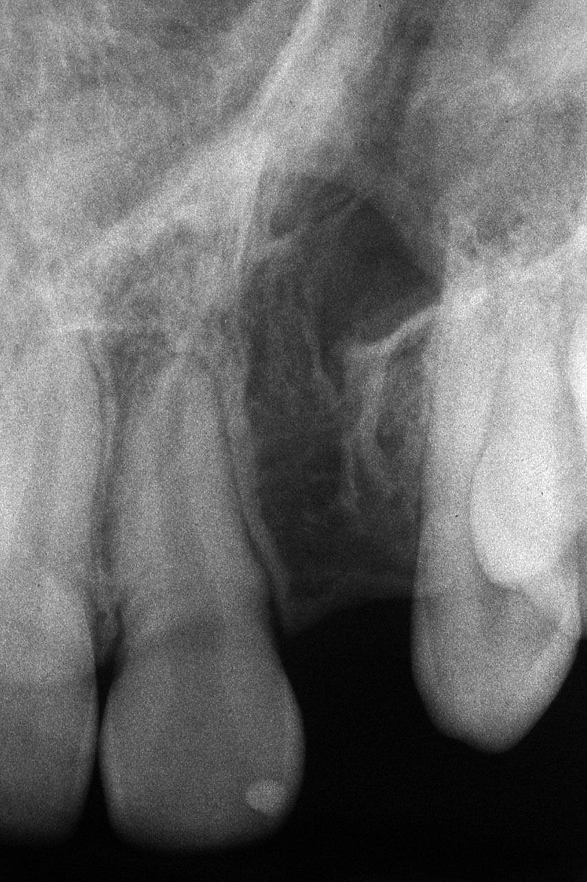 Abb. 9 Röntgenbild der Ausgangssituation, spaltbenachbarte Zähne 21 und 23 röntgenologisch unauffällig. Die knöcherne Spalte ist bindegewebig durchsetzt.