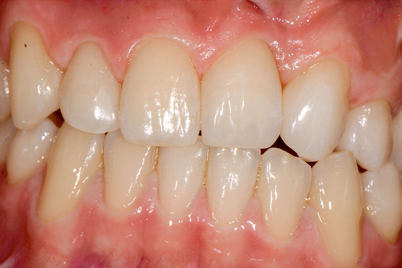 Abb. 12 Zustand nach Versorgung mit direkten Kompositfüllungen an den Zähnen 13, 12, 11, 21 und 23. Zahn 23 wurde zuvor extern gebleicht.