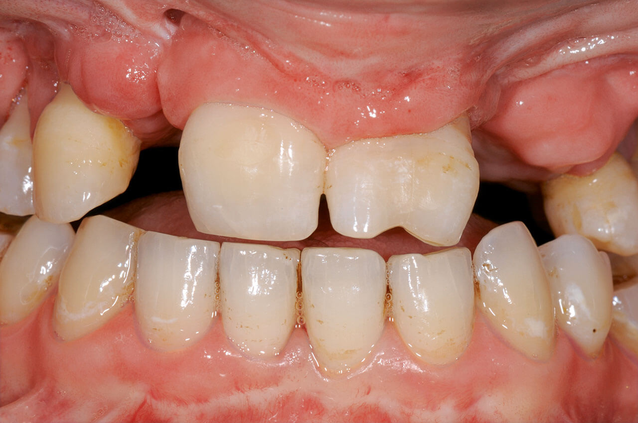 Abb. 14 Intraorale Situation der doppelseitigen LKGSpalte mit deformierten Zähnen 11 und 21 sowie multiplen Nichtanlagen.