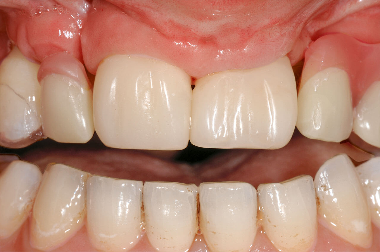 Abb. 16 Intraorale Situation nach Versorgung der Zähne 11 und 21 mit direkten Kompositveneers und Eingliederung einer herausnehmbaren KFO-Apparatur zum Ersatz der fehlenden Zähne.