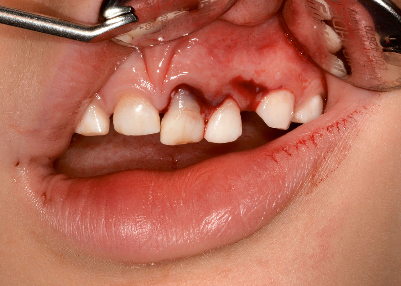 Abb. 2a und b 5-jähriger Knabe am Unfalltag mit extrudierten und nach palatinal dislozierten Zähnen 61 und 62.