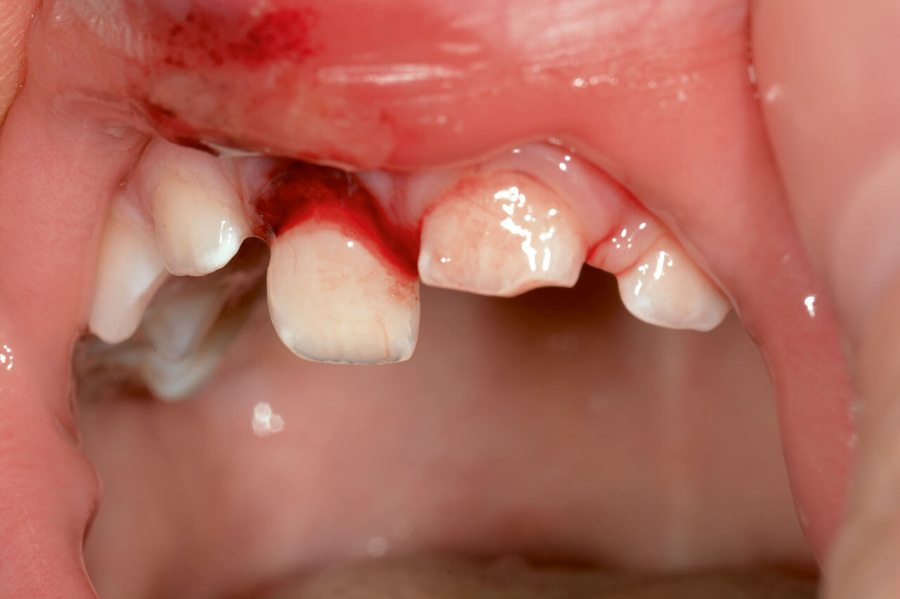 Abb. 3 Aufgrund der Gefahr eines Spontanverlustes musste Zahn 51 extrahiert werden.
