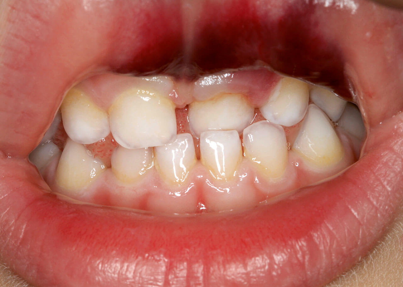 Abb. 4 Zahn 61 steht im Kreuzbiss. Da er kein Okklusionshindernis darstellt, kann er belassen werden.
