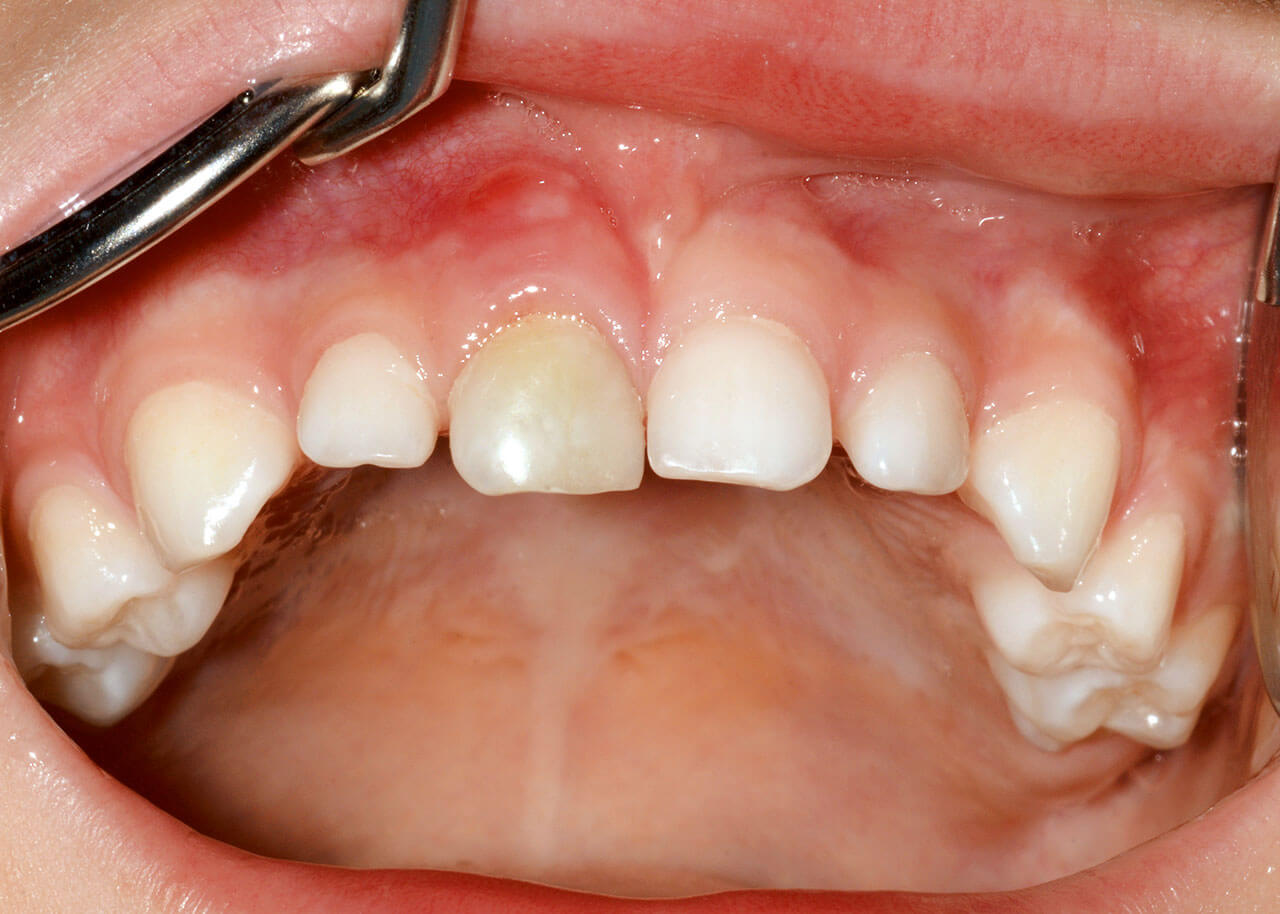 Abb. 6a und b Grauverfärbter Zahn 51 nach palatinaler Dislokationsverletzung.