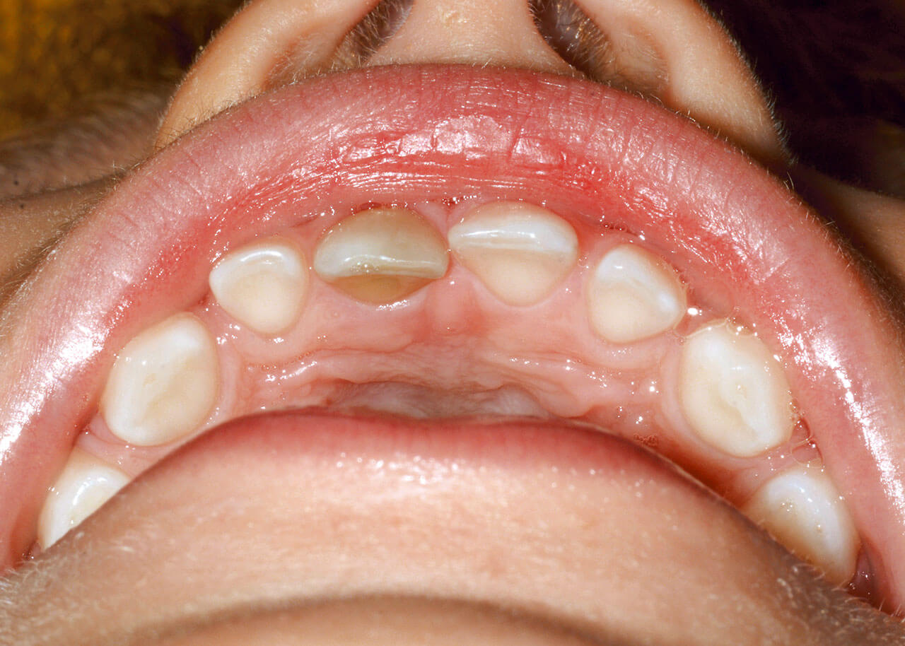 Abb. 6a und b Grauverfärbter Zahn 51 nach palatinaler Dislokationsverletzung.