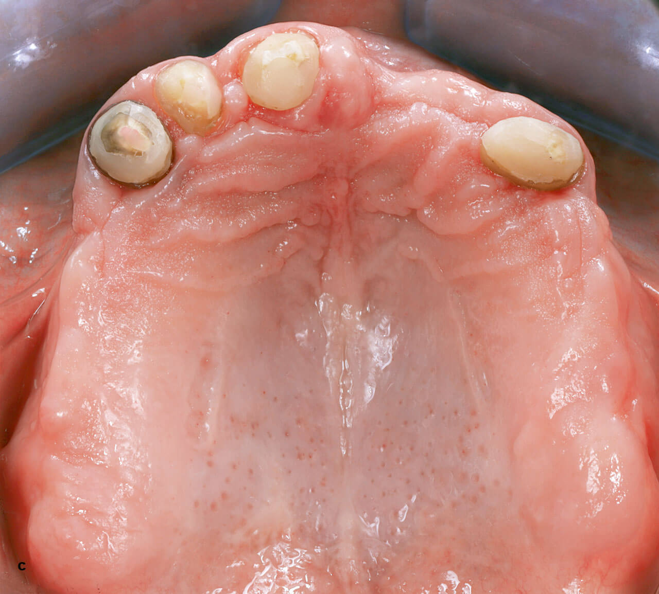 Abb. 6 c und d Nach Wurzelkanalbehandlung und Kürzung der verbleibenden Zähne wurde eine Immediatprothese abgegeben. Durch die verbesserte Passung der Prothesenbasis, der äquilibrierten Okklusion und der verbesserten Hygiene konnte eine Abheilung der entzündeten Schleimhäute erzielt werden.