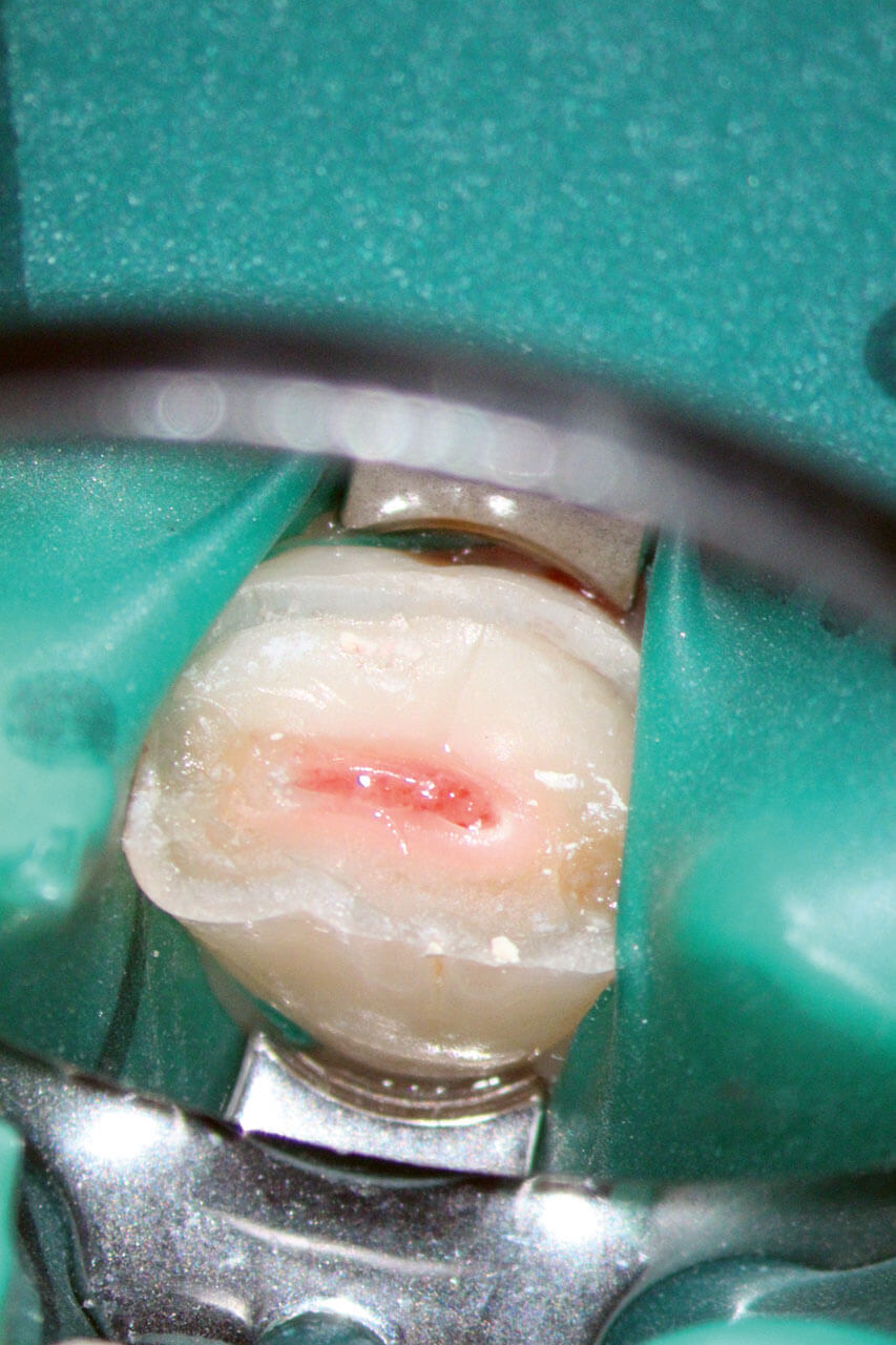 Abb. 3 Ausgangszustand von Zahn 11 vor partieller Pulpo­tomie. Unter der oberflächlichen Nekrose kann bereits durchblutetes Gewebe erahnt werden – auch 5 Tage nach erlittenem Trauma.
