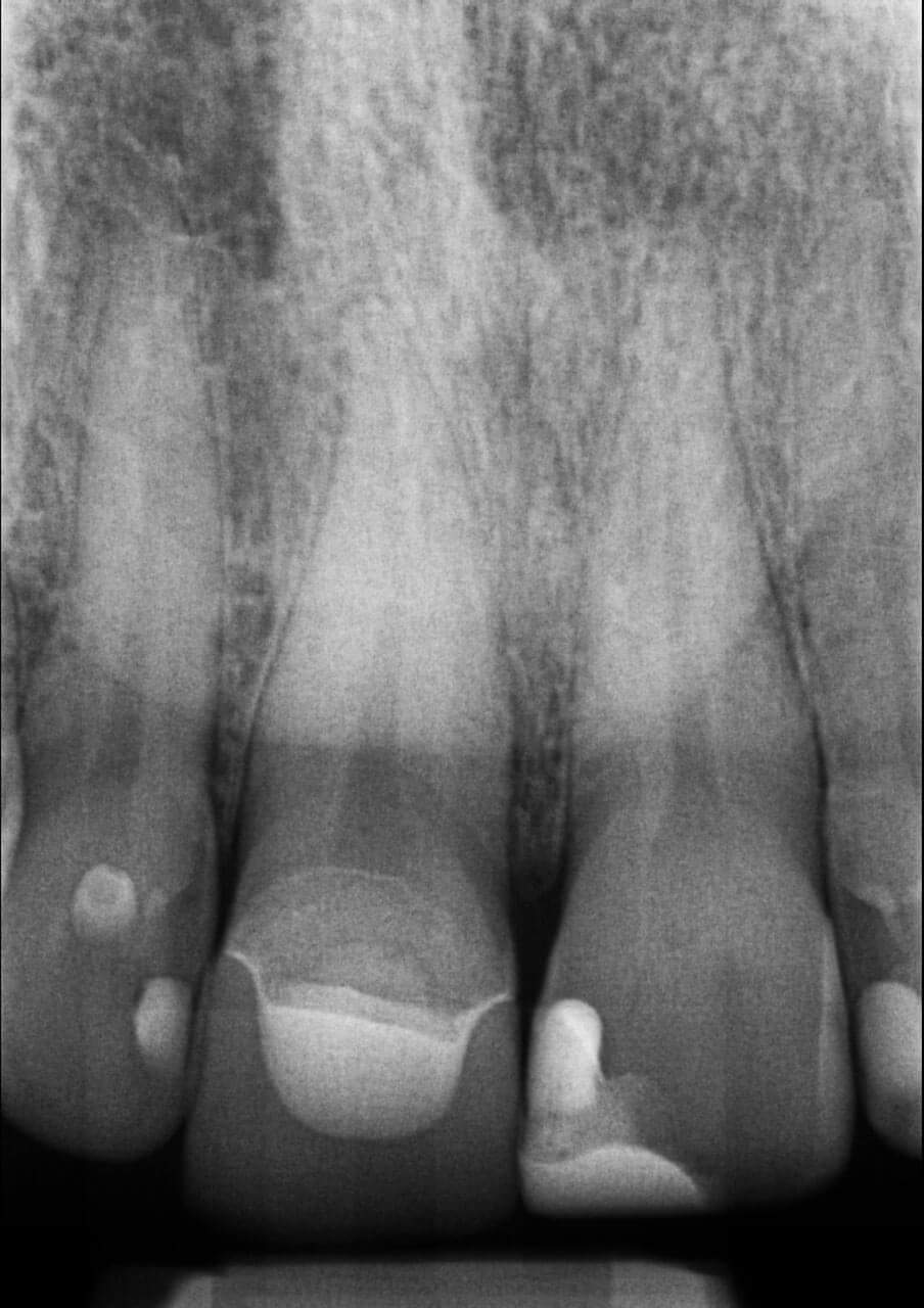 Abb. 10 Zum 12-Monats-Recall war der partiell pulpotomierte Zahn 11 sowohl klinisch als auch radiologisch unauffällig.