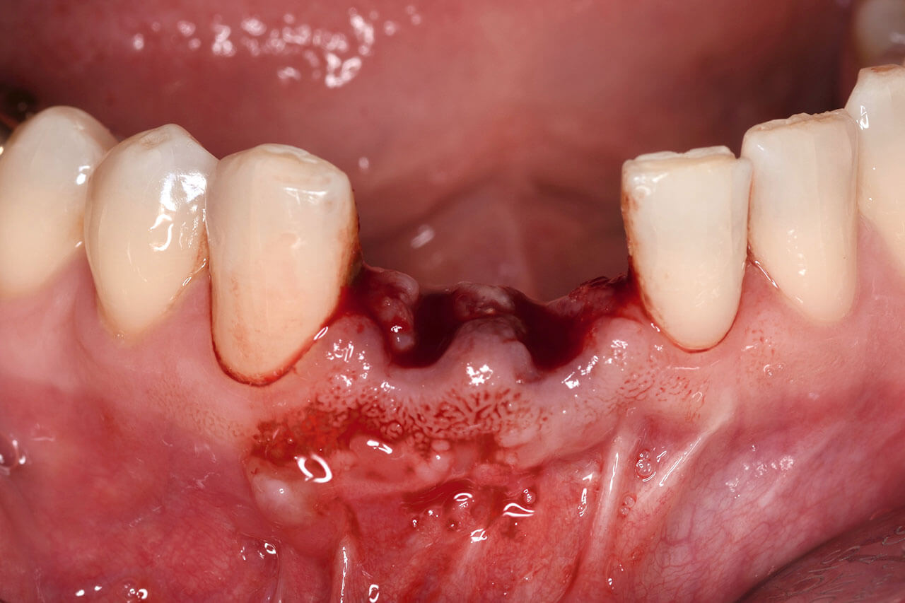 Abb. 5 Zustand nach schonender Extraktion der Zähne 41 und 42.