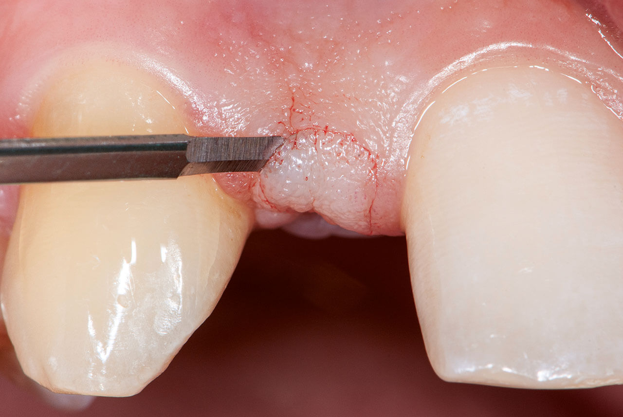 Abb. 4 Im Bereich der zukünftigen Brückenglieder wird das Weichgewebe mit einer feinen mikrochirurgischen Klinge (Keydent Micro Blade SR, Fa. American Dental Systems, Vaterstetten) entepithelisiert.