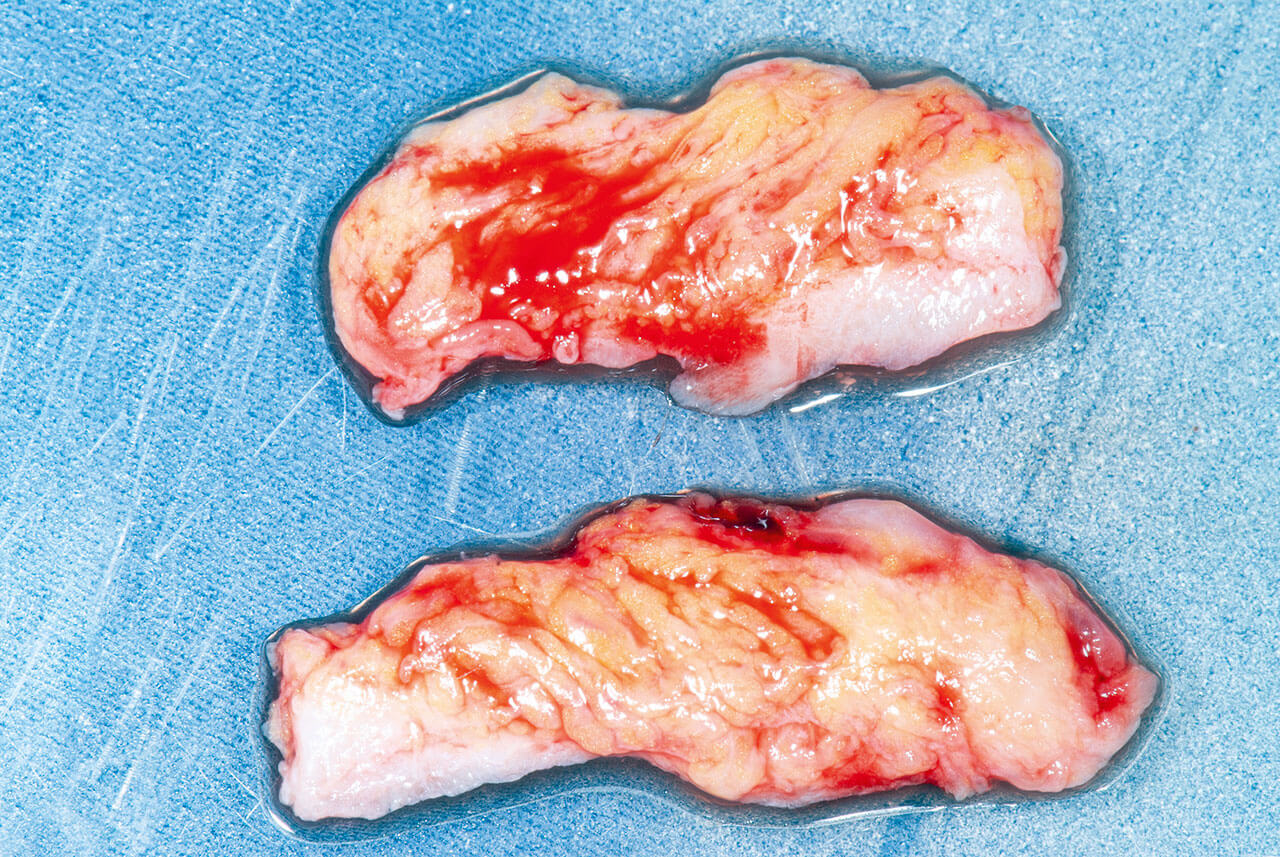 Abb. 6 Zwei mit der „Single-incision technique“ entnommene subepitheliale Bindegewebetransplantate vom lateralen Gaumen werden zur Wiederherstellung des Weichgewebevolumens genutzt.