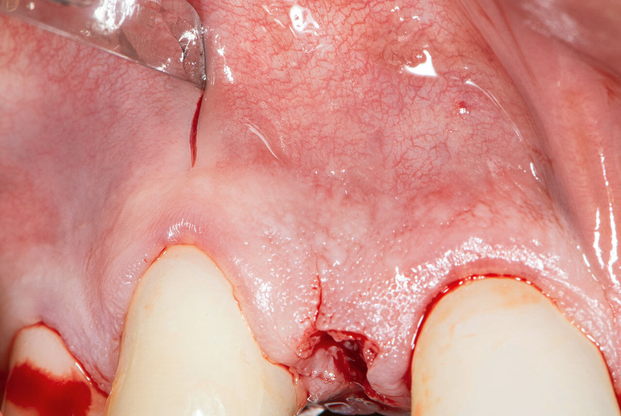 Abb. 7 Auf Höhe der Eckzähne wird jeweils eine kleine vertikale Inzision gesetzt, welche auf die bewegliche Alveolarmukosa begrenzt ist.
